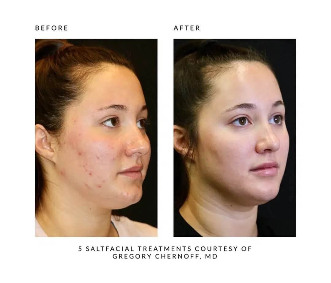 Before and After images of salt facial
