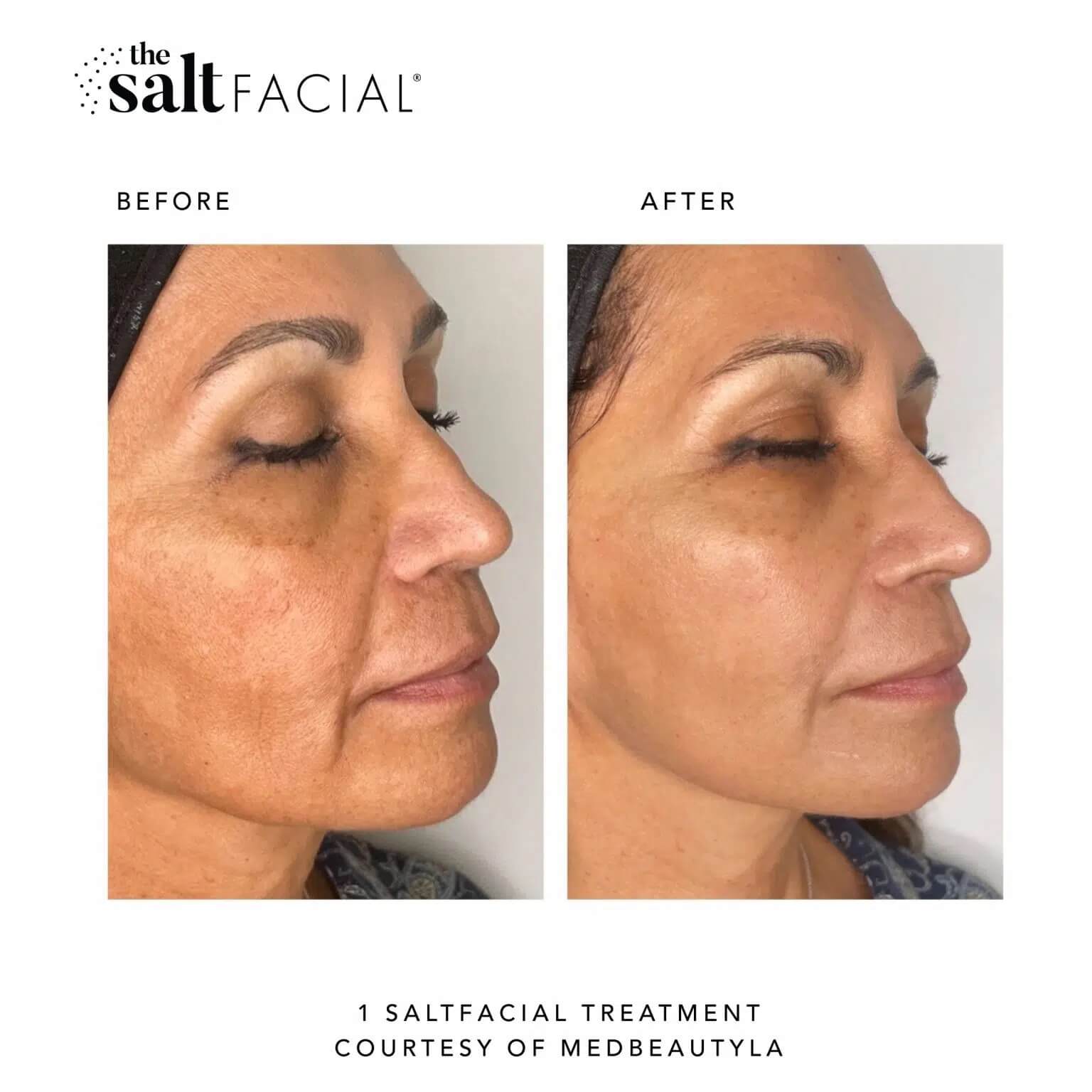 Before and After images | Sei tu bella aesthetics