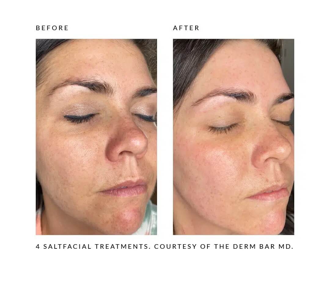 Before and After images | Sei tu bella aesthetics